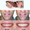 HappyBite™ - Prothèses dentaires ajustables pour un sourire heureux | Dernier jour 75% de réduction